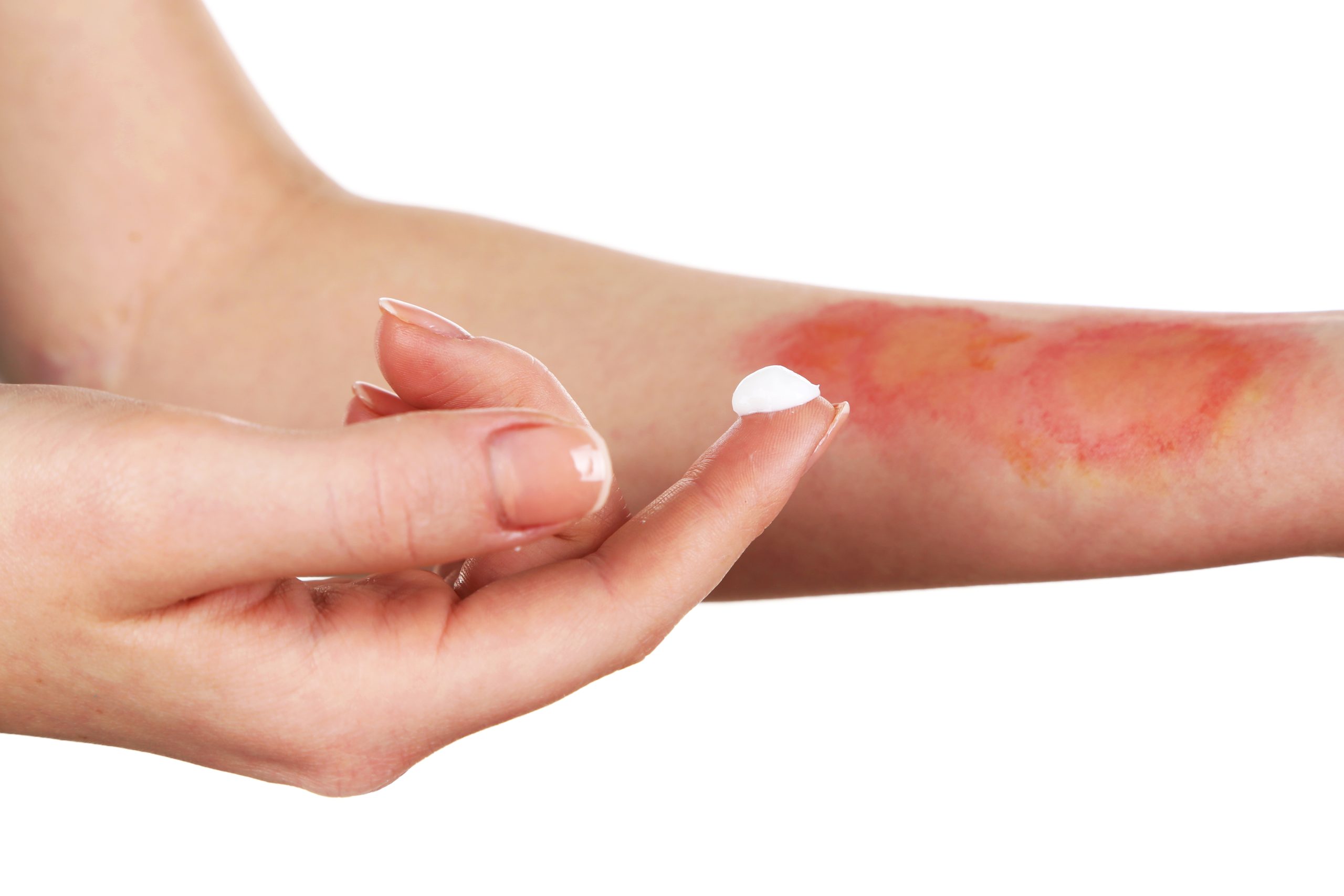 treatment burns female hand isolated white scaled 1 جدیدترین روش‌های درمان جای سوختگی با لیزر و تکنیک‌های مدرن زیبایی