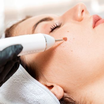 Professional salon procedures. Surgeon using a laser device for removing mole. Removal of birthmark from female face. Close up. Concept of laser cosmelotogy and electrocoagulation.